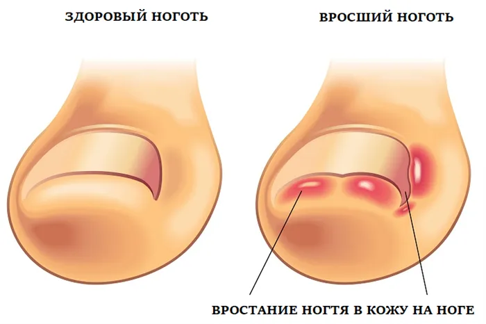 Как выглядят зараженные ногти