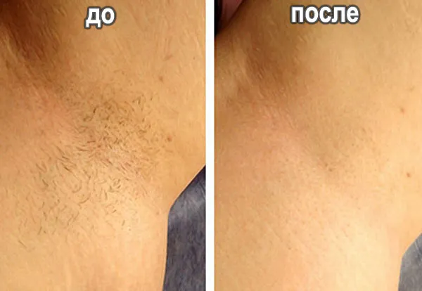 Эпиляция Ambere: до и после